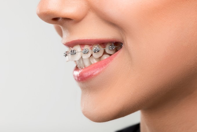факторы влияющие на срок ношения брекетов